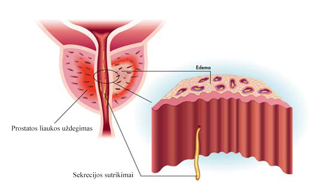 gydymas prostatitu ir erekcijos stoka lytiniu organu nariu dydziu dydis